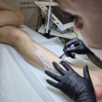 Електроепіляція ніжки
      