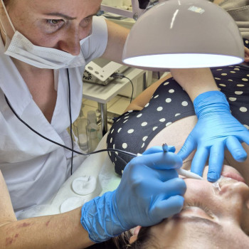 Електроепіляція обличчя
      