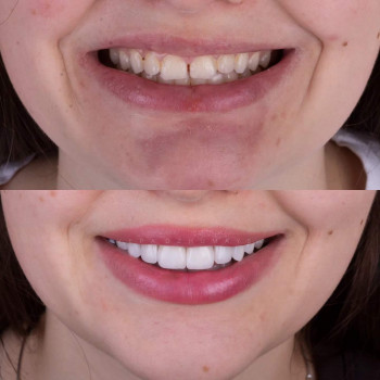 Керамічні вініри, фото - стоматолог Вепа Джумаев