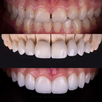 Керамічні вініри, фото - стоматолог Вепа Джумаев