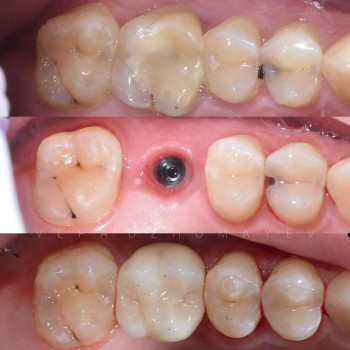 Імплантація, фото - стоматолог Вепа Джумаев