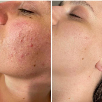 Чистка шкіри комбінована в поєднанні з пілінгом
                    Лікар-косметолог Юлія Луцьк