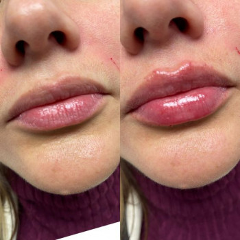 Збільшення губ препаратом Juvederm — Ідеальний контур і об'єм губ
                    Врач-косметолог Юлія Луцк