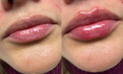 Збільшення губ препаратом Juvederm — Ідеальний контур і об'єм губ Врач-косметолог Юлія Луцк