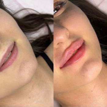 Збільшення губ препаратом Juvederm — Ідеальний контур і об'єм губ
                    Врач-косметолог Юлія Луцк