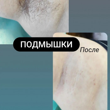 Депиляция воском
                    Мастер депиляции Виталина Полтава