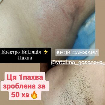 Електроепіляція
                    Майстер депіляції Виталина Полтава