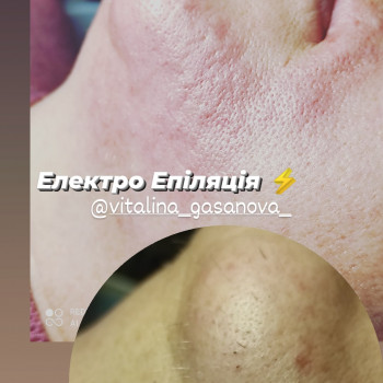 Електроепіляція
                    Майстер депіляції Виталина Полтава