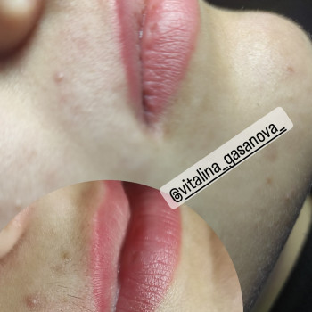 Електроепіляція
                    Майстер депіляції Виталина Полтава