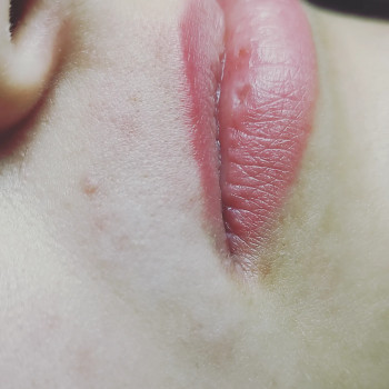 Електроепіляція
                    Майстер депіляції Виталина Полтава