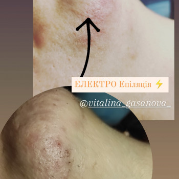Електроепіляція
                    Майстер депіляції Виталина Полтава