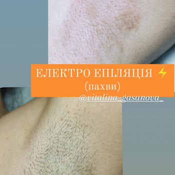 Електроепіляція
                    Майстер депіляції Виталина Полтава