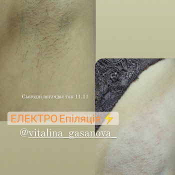 Електроепіляція
                    Майстер депіляції Виталина Полтава