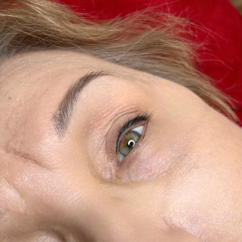 Загоєна міжвійка