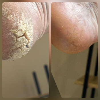 Обробка тріщин на пʼятках
                    Подолог Андрей Одесса