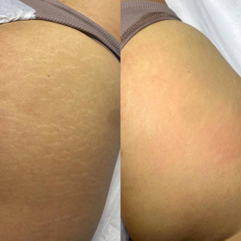 Результат після процедури. Лікування розтяжок

 