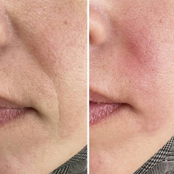 Результат після процедури. Прибрали носогубні зморшки

 #дермапен #зморшки