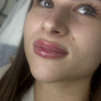 Побажання пацієнтки обʼєм губ. Обʼєм препарату 0,6 мл. Повторна корекція.