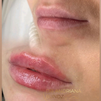 Збільшення обʼєму губ та корекція форми. Поетапний результат.