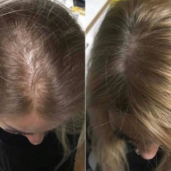 Екзосоми. Лікування випадіння волосся
  