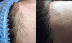 Електроепіляція тіла Электролог Альона Вышгород