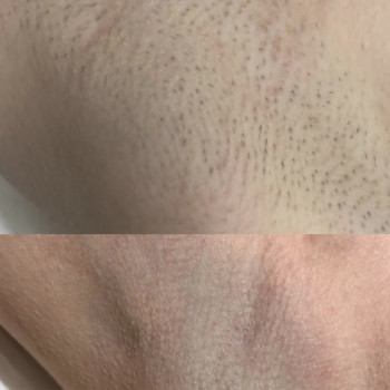 Результат після 6-Ї процедури, фото - майстер лазерної епіляції Юлия Сніжко