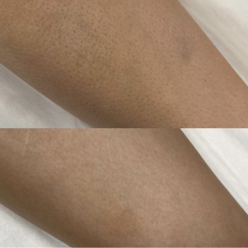 До/ після, фото - майстер лазерної епіляції Юлия Сніжко