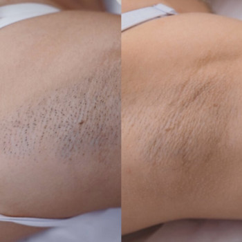 Результат побачите після першої процедури, фото - майстер лазерної епіляції Юлия Сніжко