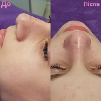 Чистка обличчя / пілінг обличчя
                    Салон краси J-BLENS Суми