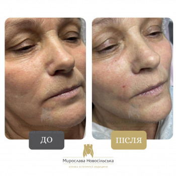 Результати бланшування до і після в Ужгороді