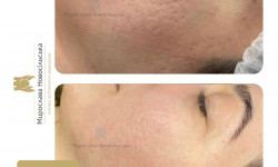 Біоревіталізація Косметологический центр Клініка естетичної медицини Мирослави Новосільської Ужгород