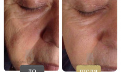 Безопераційна підтяжка обличчя – термоліфтинг NIR Косметологический центр Клініка естетичної медицини Мирослави Новосільської Ужгород