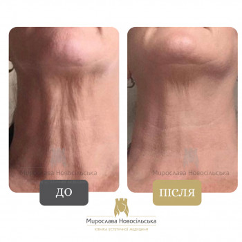 термоліфтинг шиї