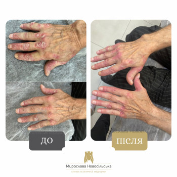 лікування псоріазу