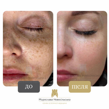 видалення пігментації лазером