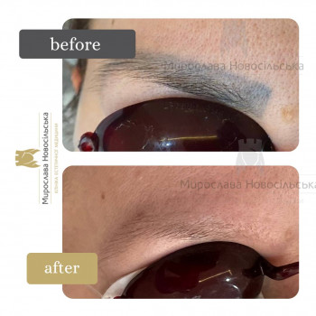 лазерне видалення татуажу