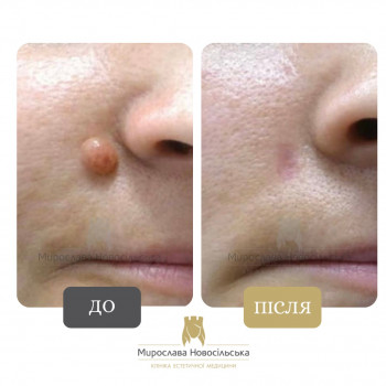 лазерне видалення родимки