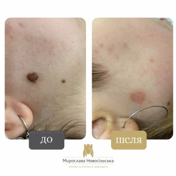 лазерне видалення родимки