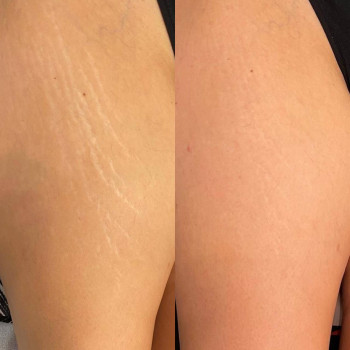 До/загоєний після 1 процедури
 