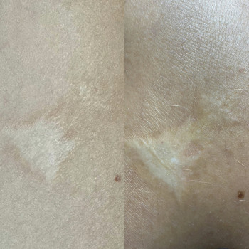 Загоєний після 1 процедури/до
 