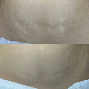 До/загоєний після 1 процедури 
 