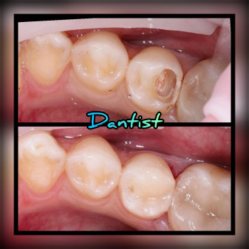 ДИТЯЧИЙ СТОМАТОЛОГ
Лікую зубки БЕЗ БОЛЮ ТА СЛІЗ