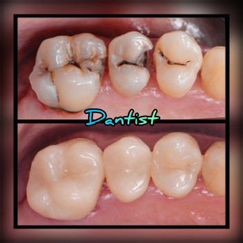 ДИТЯЧИЙ СТОМАТОЛОГ
Лікую зубки БЕЗ БОЛЮ ТА СЛІЗ