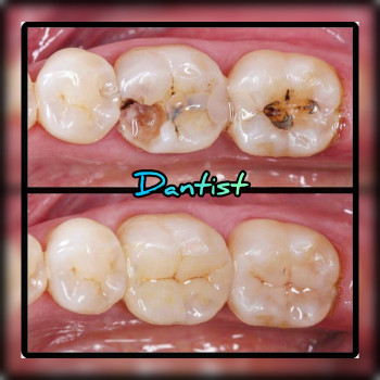 ДИТЯЧИЙ СТОМАТОЛОГ
Лікую зубки БЕЗ БОЛЮ ТА СЛІЗ