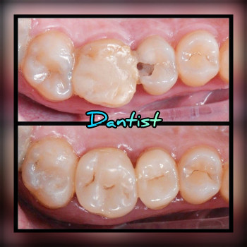 ДИТЯЧИЙ СТОМАТОЛОГ
Лікую зубки БЕЗ БОЛЮ ТА СЛІЗ

  
  
 