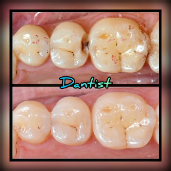 ДИТЯЧИЙ СТОМАТОЛОГ
Лікую зубки БЕЗ БОЛЮ ТА СЛІЗ

  
 
  
 
 
 