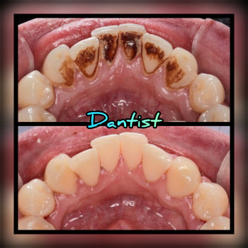 ДИТЯЧИЙ СТОМАТОЛОГ
Лікую зубки БЕЗ БОЛЮТА СЛІЗ