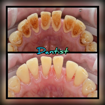 ДИТЯЧИЙ СТОМАТОЛОГ
Лікую зубки БЕЗ БОЛЮ ТА СЛІЗ