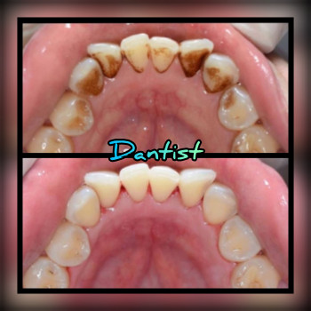 ДИТЯЧИЙ СТОМАТОЛОГ
Лікую зубки БУЗ БОЛЮ ТА СЛІЗ