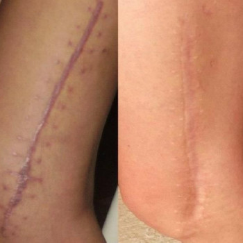 Корекція кольору рубця 4 процедури мікронідлінгу